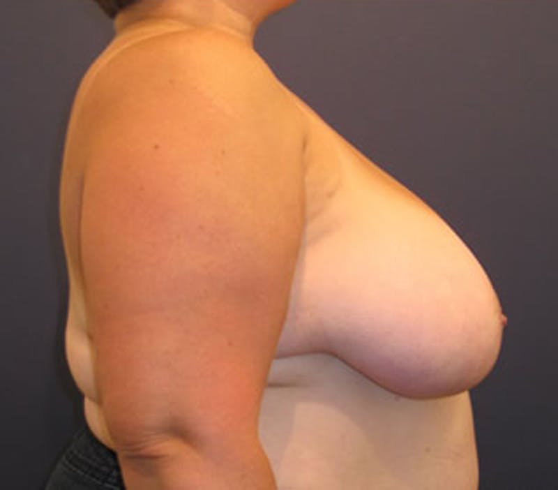 Breast Reduction Before & After Gallery - Patient 174162069 - Image 6