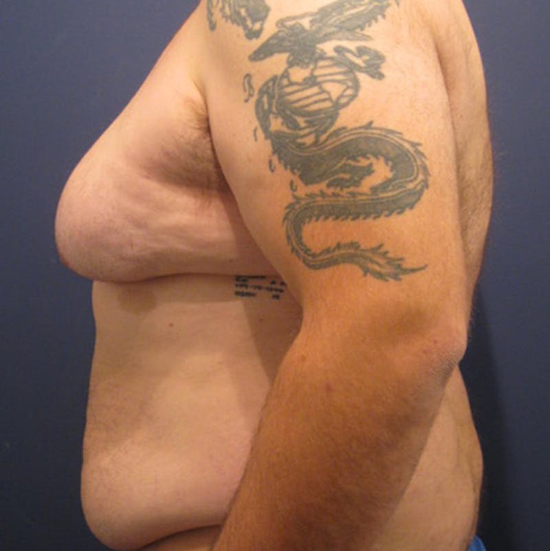 Male Breast Reduction/Gynecomastia Before & After Gallery - Patient 174148881 - Image 5