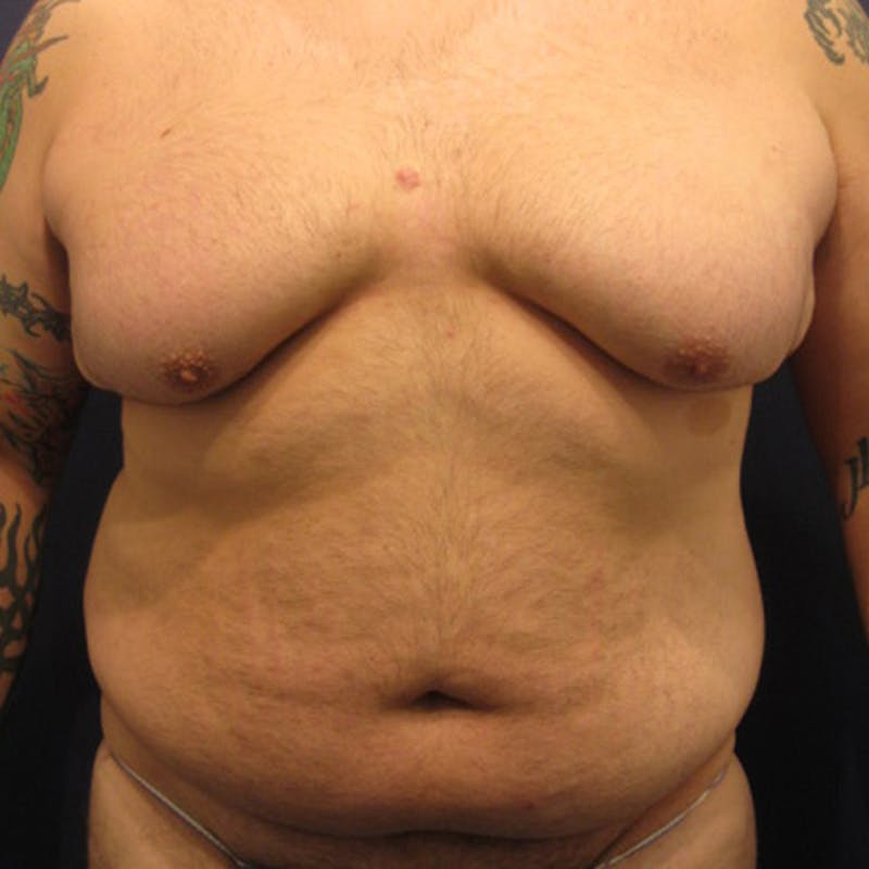 Male Breast Reduction/Gynecomastia Before & After Gallery - Patient 174148881 - Image 1