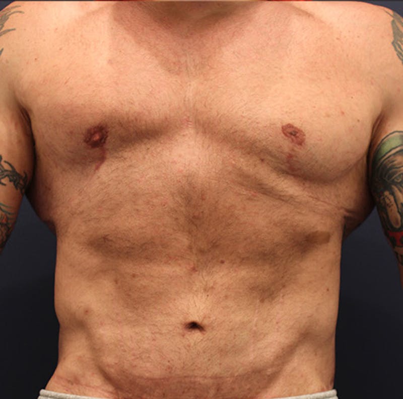 Male Breast Reduction/Gynecomastia Before & After Gallery - Patient 174148881 - Image 2