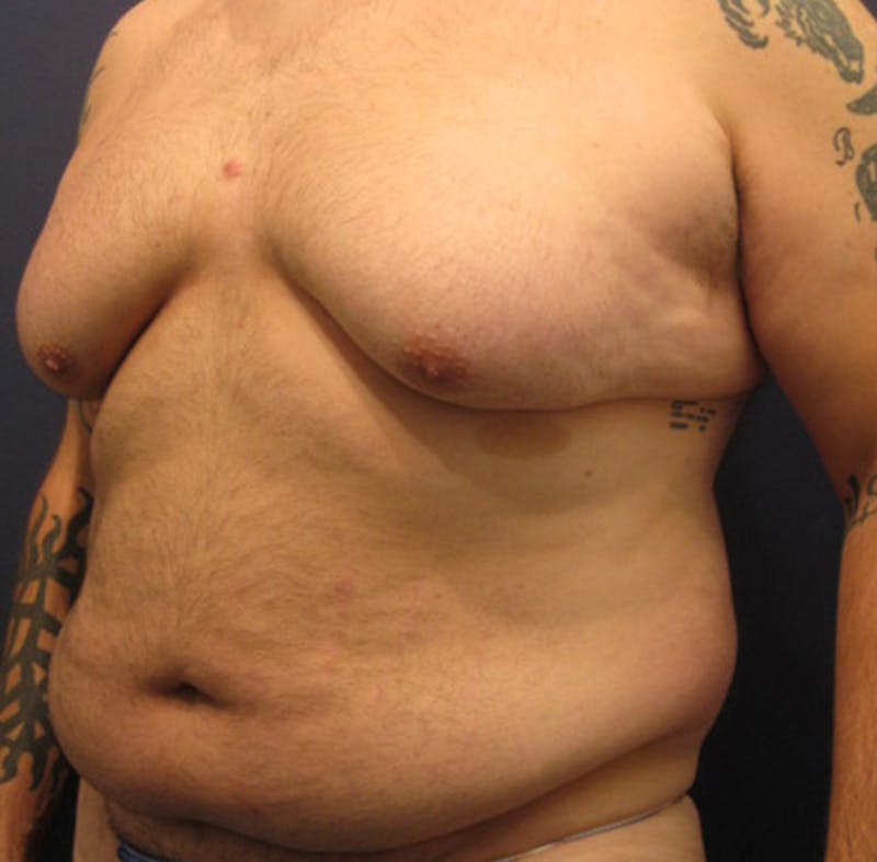 Male Breast Reduction/Gynecomastia Before & After Gallery - Patient 174148881 - Image 3