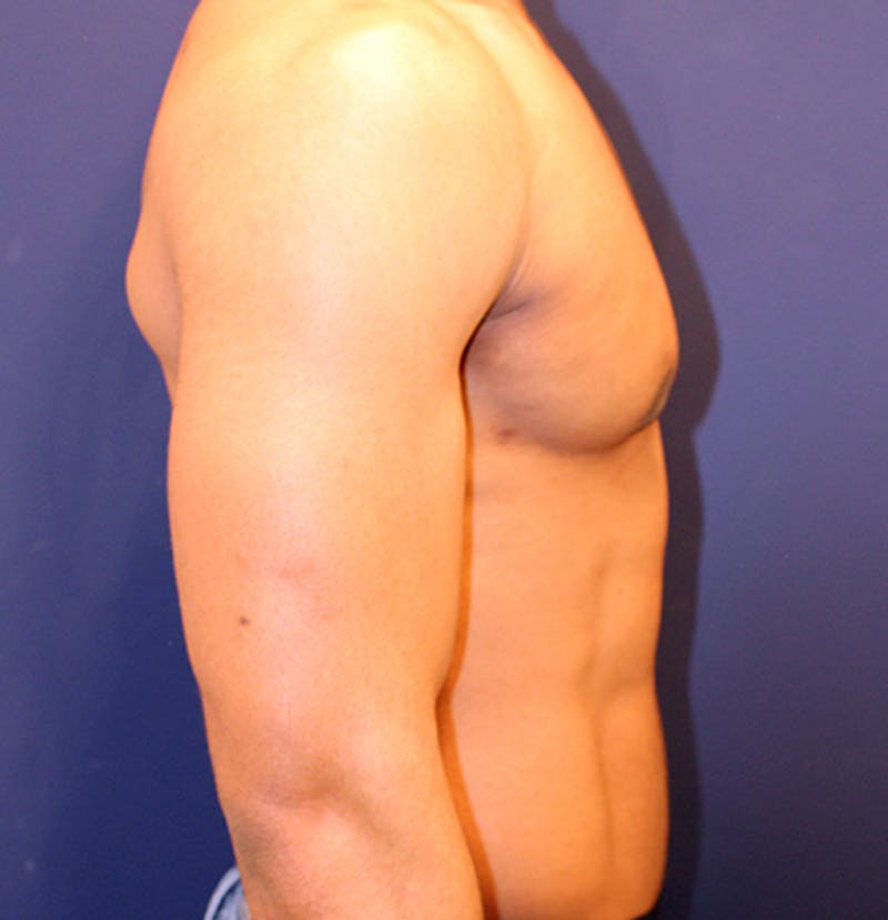 Male Breast Reduction/Gynecomastia Before & After Gallery - Patient 174149963 - Image 6