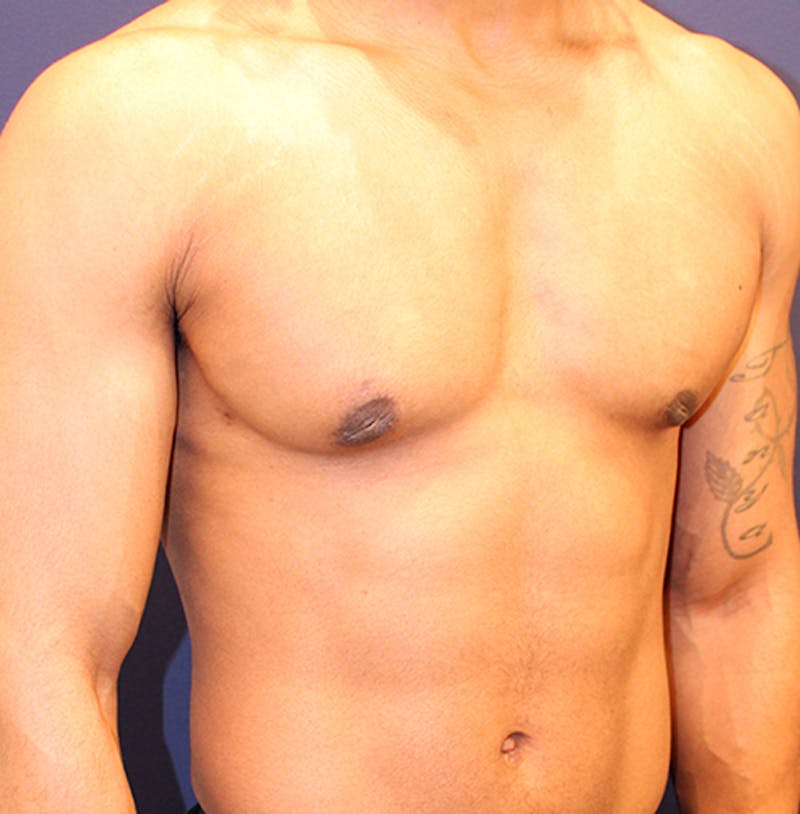 Male Breast Reduction/Gynecomastia Before & After Gallery - Patient 174149963 - Image 4