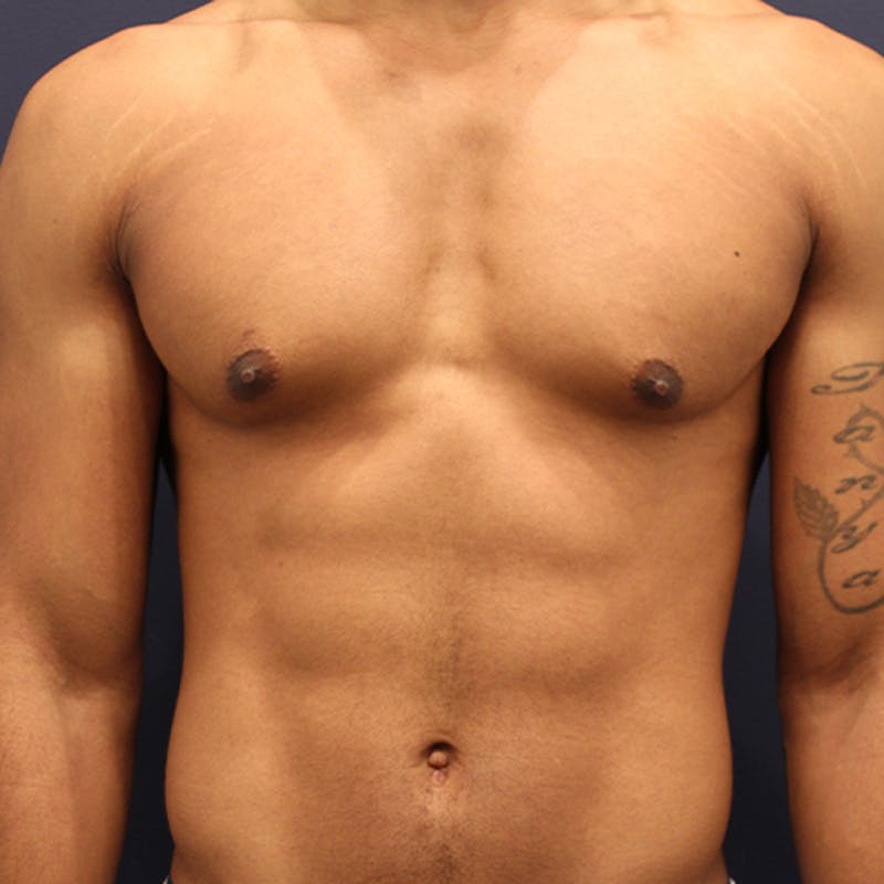 Male Breast Reduction/Gynecomastia Before & After Gallery - Patient 174149963 - Image 1