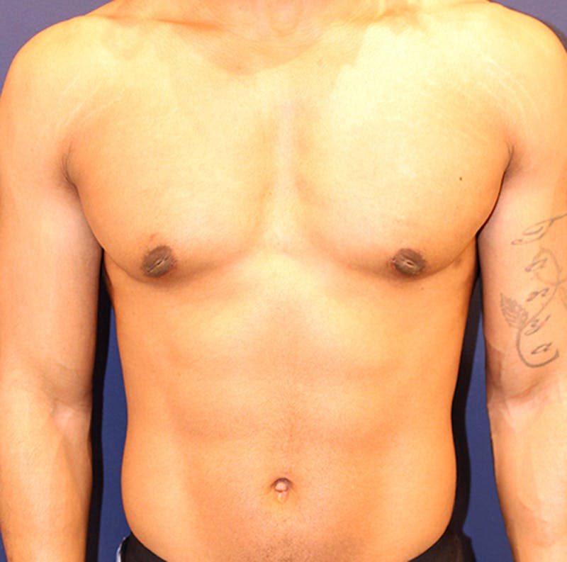 Male Breast Reduction/Gynecomastia Before & After Gallery - Patient 174149963 - Image 2