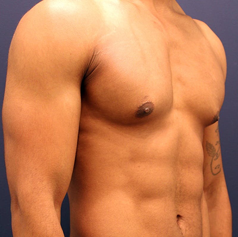 Male Breast Reduction/Gynecomastia Before & After Gallery - Patient 174149963 - Image 3