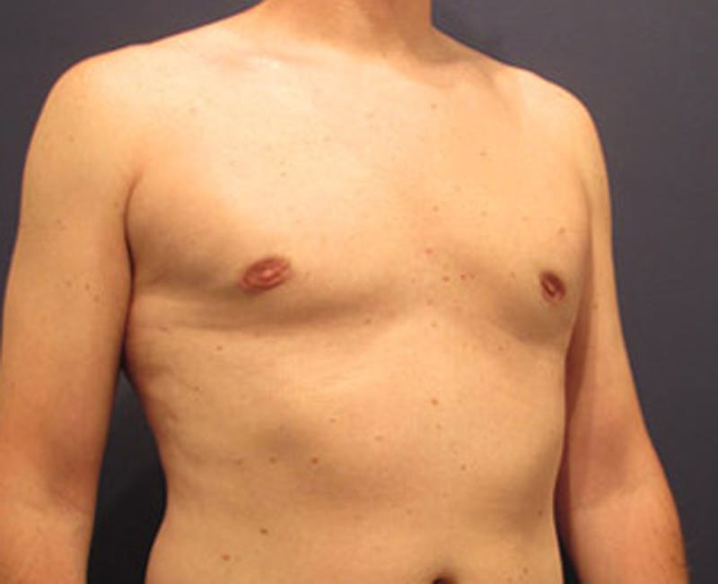 Male Breast Reduction/Gynecomastia Before & After Gallery - Patient 174149969 - Image 4