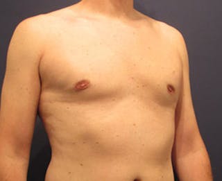 Male Breast Reduction/Gynecomastia Before & After Gallery - Patient 174149969 - Image 4