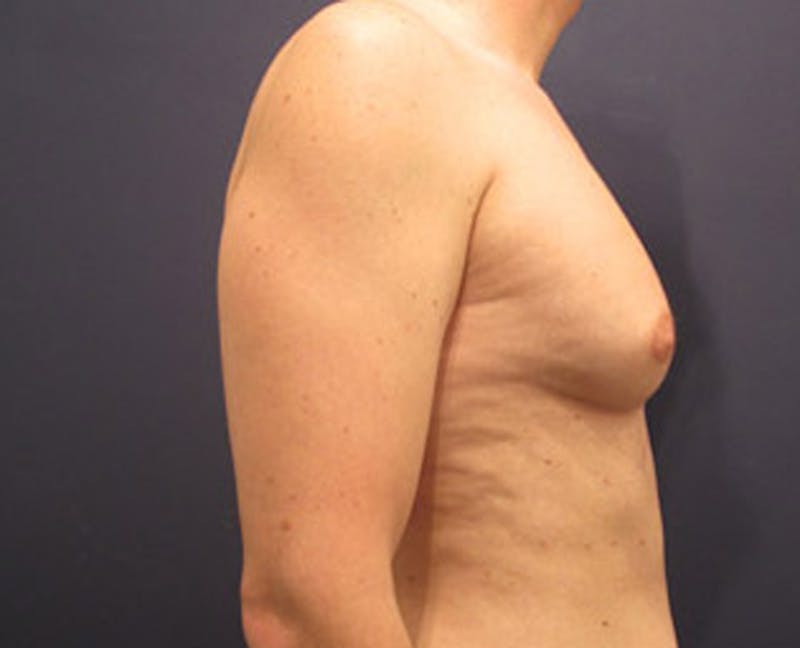 Male Breast Reduction/Gynecomastia Before & After Gallery - Patient 174149969 - Image 5