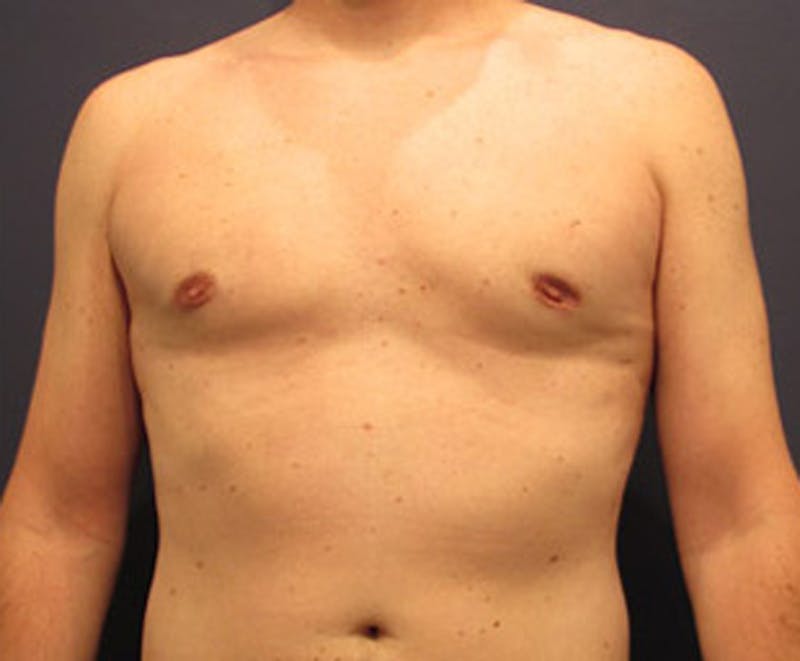 Male Breast Reduction/Gynecomastia Before & After Gallery - Patient 174149969 - Image 2