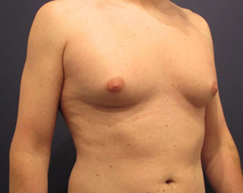 Male Breast Reduction/Gynecomastia Before & After Gallery - Patient 174149969 - Image 3