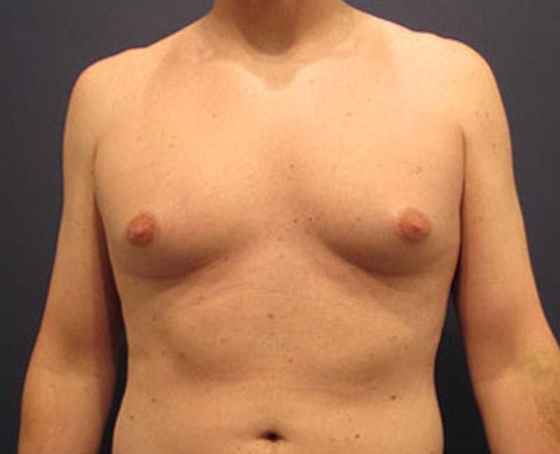 Male Breast Reduction/Gynecomastia Before & After Gallery - Patient 174149969 - Image 1