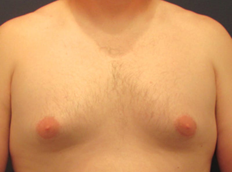 Male Breast Reduction/Gynecomastia Before & After Gallery - Patient 174149978 - Image 1