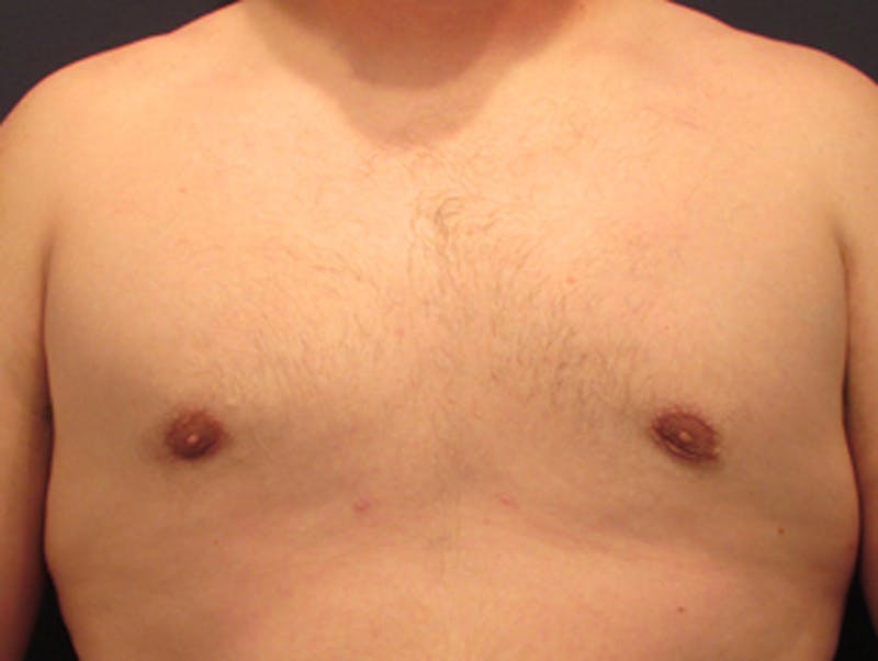 Male Breast Reduction/Gynecomastia Before & After Gallery - Patient 174149978 - Image 2