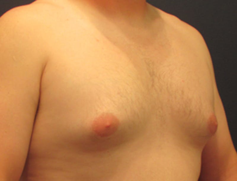 Male Breast Reduction/Gynecomastia Before & After Gallery - Patient 174149978 - Image 3