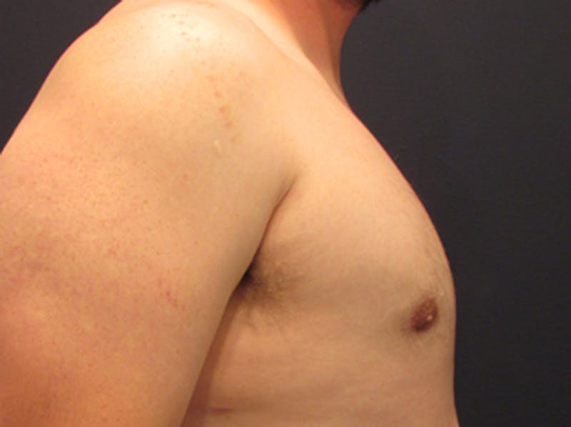 Male Breast Reduction/Gynecomastia Before & After Gallery - Patient 174149978 - Image 6