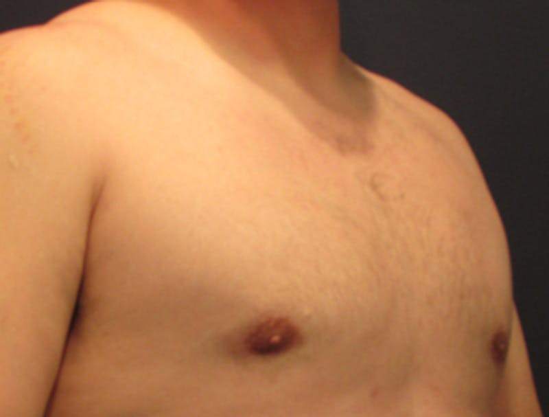 Male Breast Reduction/Gynecomastia Before & After Gallery - Patient 174149978 - Image 4