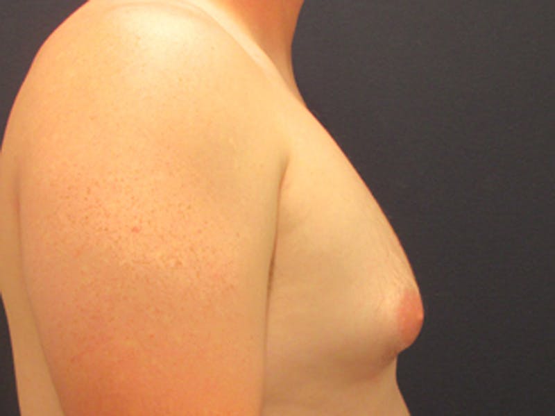 Male Breast Reduction/Gynecomastia Before & After Gallery - Patient 174149978 - Image 5