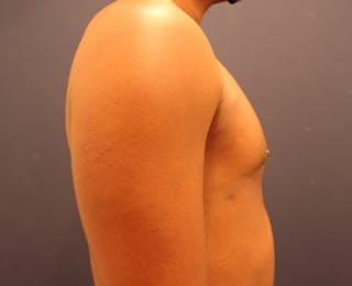 Male Breast Reduction/Gynecomastia Before & After Gallery - Patient 174149984 - Image 6