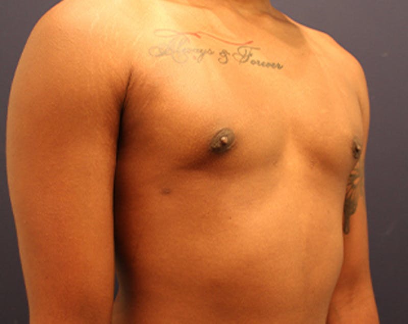 Male Breast Reduction/Gynecomastia Before & After Gallery - Patient 174149984 - Image 4