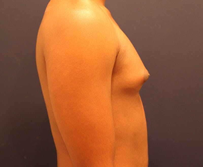 Male Breast Reduction/Gynecomastia Before & After Gallery - Patient 174149984 - Image 5