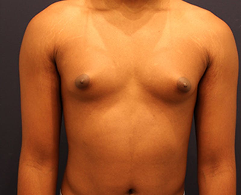 Male Breast Reduction/Gynecomastia Before & After Gallery - Patient 174149984 - Image 1