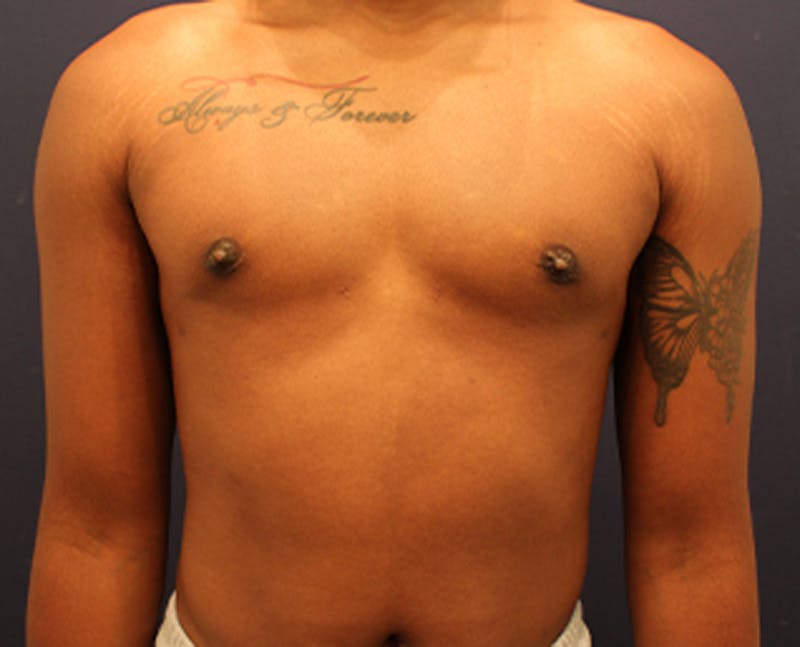 Male Breast Reduction/Gynecomastia Before & After Gallery - Patient 174149984 - Image 2