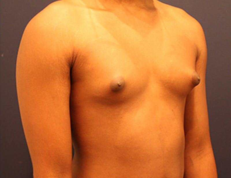 Male Breast Reduction/Gynecomastia Before & After Gallery - Patient 174149984 - Image 3
