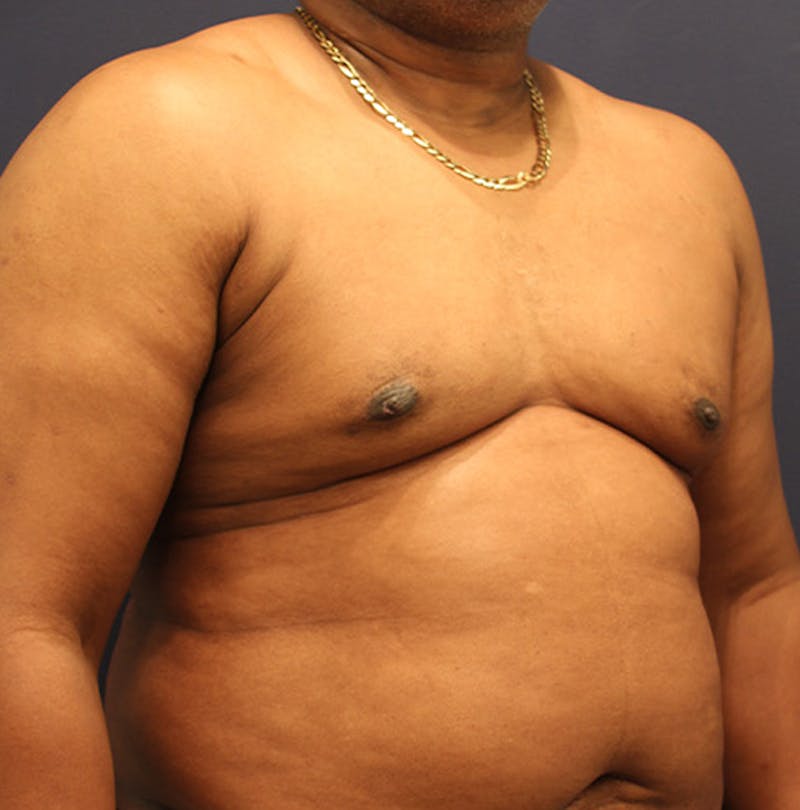 Male Breast Reduction/Gynecomastia Before & After Gallery - Patient 174149996 - Image 4