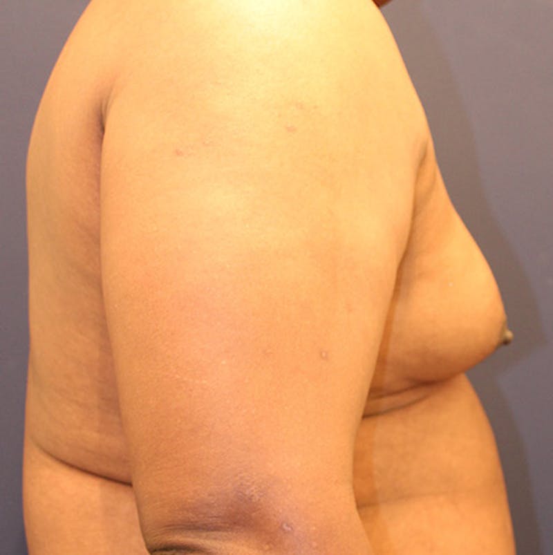 Male Breast Reduction/Gynecomastia Before & After Gallery - Patient 174149996 - Image 5