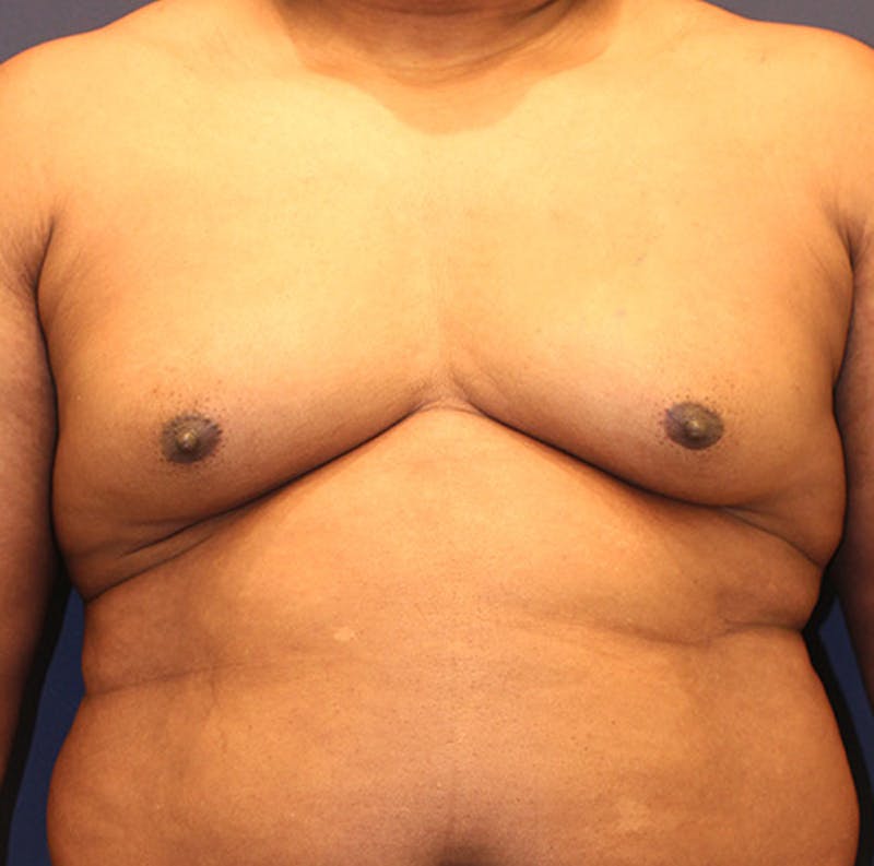 Male Breast Reduction/Gynecomastia Before & After Gallery - Patient 174149996 - Image 1