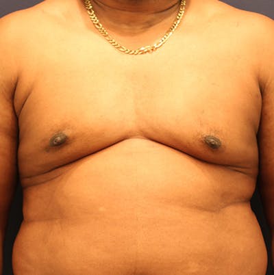 Male Breast Reduction/Gynecomastia Before & After Gallery - Patient 174149996 - Image 2