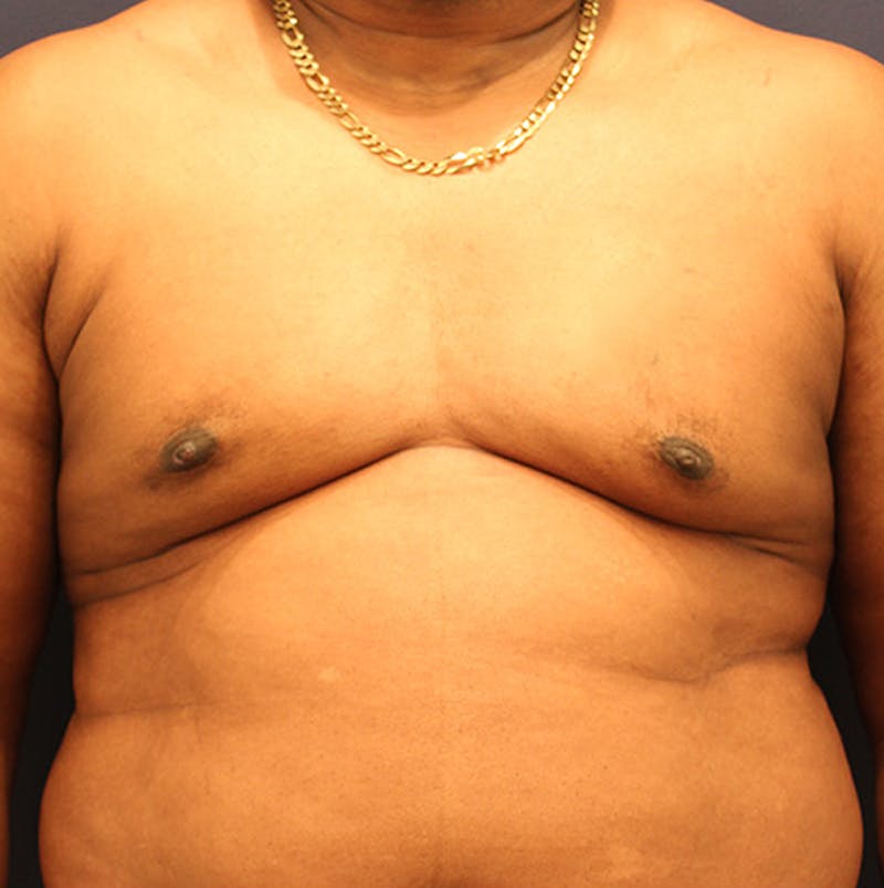Male Breast Reduction/Gynecomastia Before & After Gallery - Patient 174149996 - Image 2