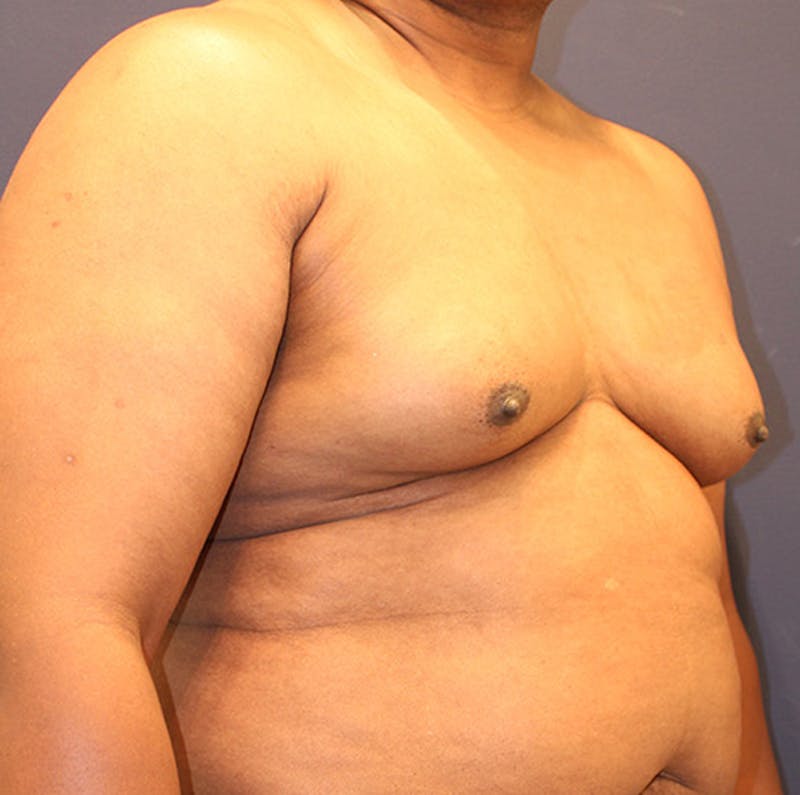 Male Breast Reduction/Gynecomastia Before & After Gallery - Patient 174149996 - Image 3