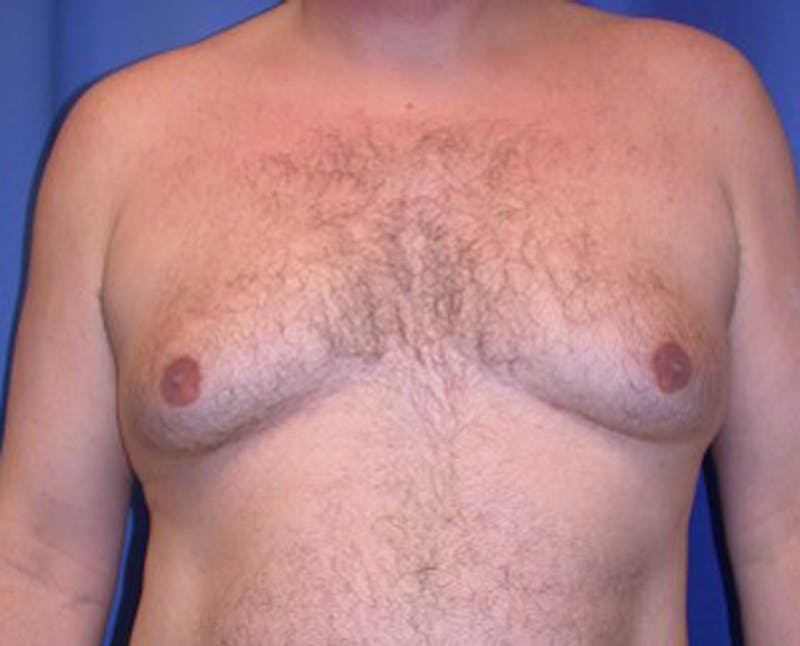 Male Breast Reduction/Gynecomastia Before & After Gallery - Patient 174150002 - Image 1