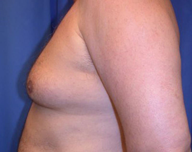 Male Breast Reduction/Gynecomastia Before & After Gallery - Patient 174150002 - Image 3