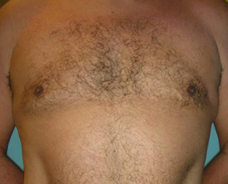 Male Breast Reduction/Gynecomastia Before & After Gallery - Patient 174150002 - Image 2