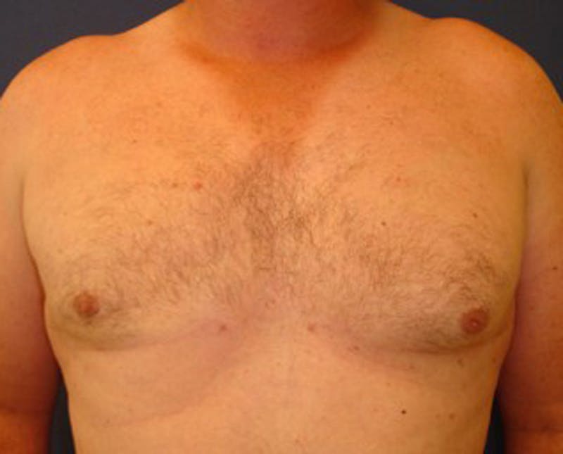 Male Breast Reduction/Gynecomastia Before & After Gallery - Patient 174150005 - Image 2