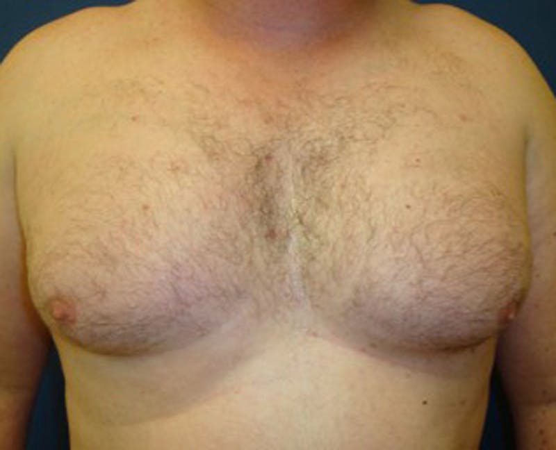 Male Breast Reduction/Gynecomastia Before & After Gallery - Patient 174150005 - Image 1
