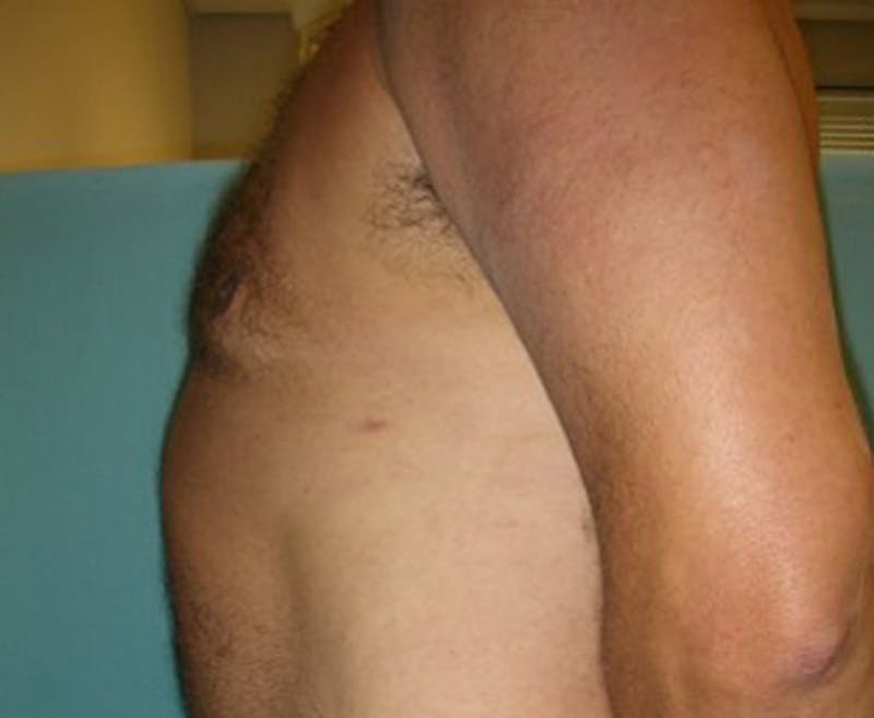 Male Breast Reduction/Gynecomastia Before & After Gallery - Patient 174150002 - Image 4