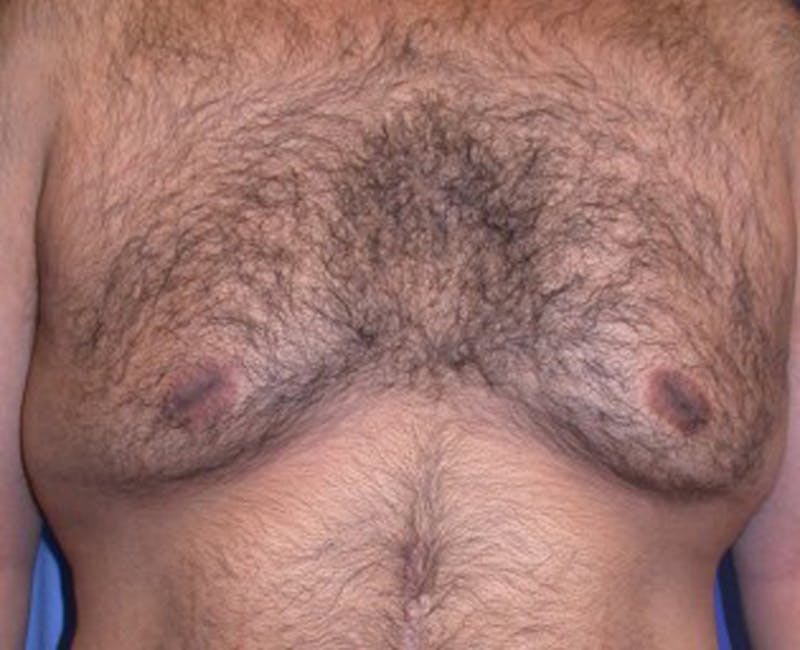 Male Breast Reduction/Gynecomastia Before & After Gallery - Patient 174150009 - Image 1