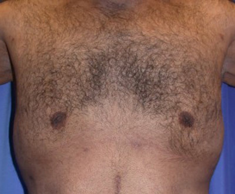 Male Breast Reduction/Gynecomastia Before & After Gallery - Patient 174150009 - Image 2