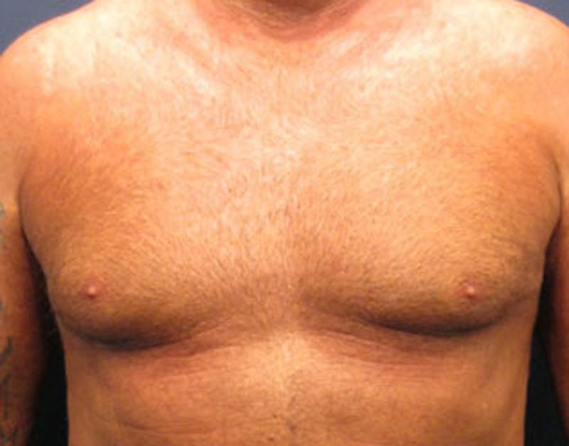 Male Breast Reduction/Gynecomastia Before & After Gallery - Patient 174150014 - Image 2