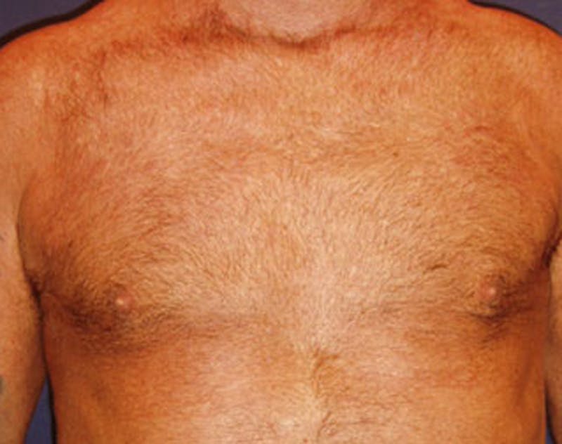 Male Breast Reduction/Gynecomastia Before & After Gallery - Patient 174150014 - Image 3