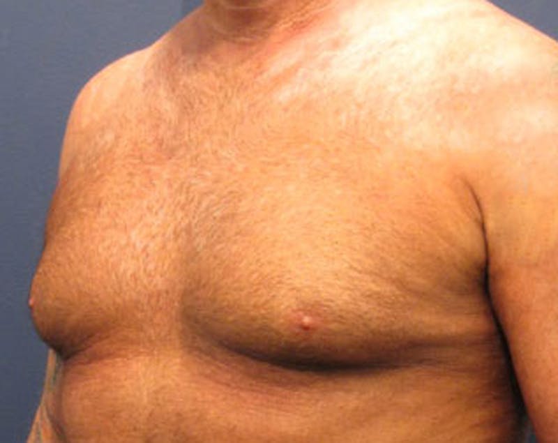 Male Breast Reduction/Gynecomastia Before & After Gallery - Patient 174150014 - Image 4