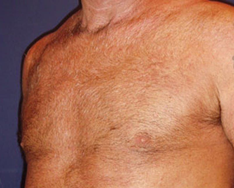 Male Breast Reduction/Gynecomastia Before & After Gallery - Patient 174150014 - Image 5