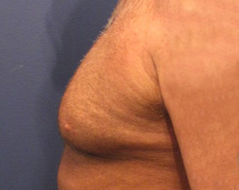 Male Breast Reduction/Gynecomastia Before & After Gallery - Patient 174150014 - Image 6