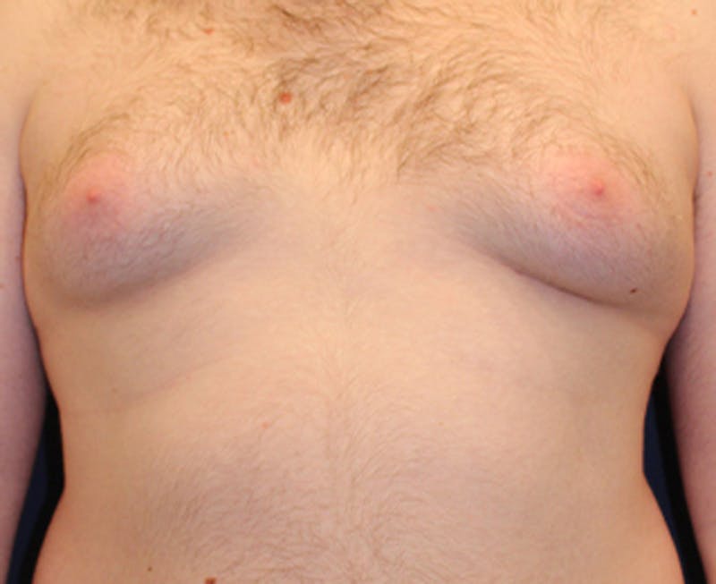 Male Breast Reduction/Gynecomastia Before & After Gallery - Patient 174150020 - Image 2