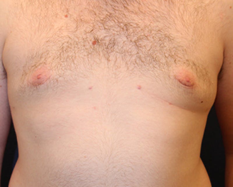 Male Breast Reduction/Gynecomastia Before & After Gallery - Patient 174150020 - Image 3
