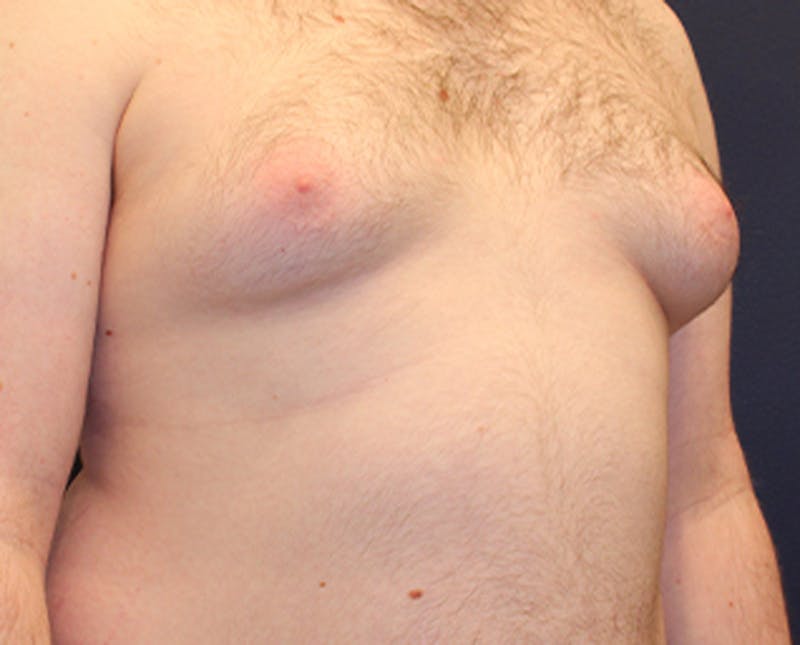 Male Breast Reduction/Gynecomastia Before & After Gallery - Patient 174150020 - Image 4